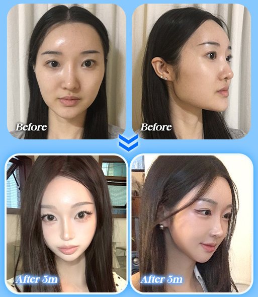 양악+윤곽 전후 사진 CASE 2(정면·측면 Before / After 3m)
