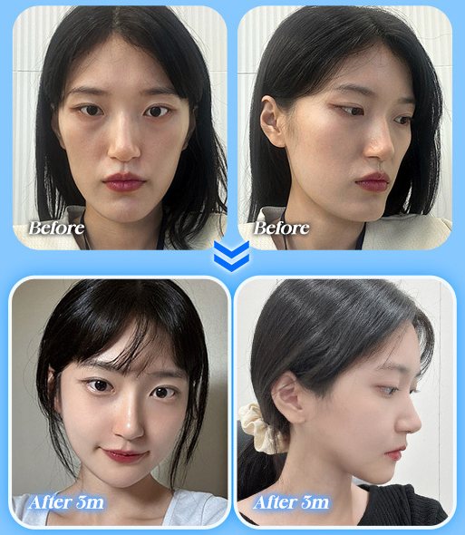 양악+윤곽 전후 사진 CASE 3(정면·측면 Before / After 3m)