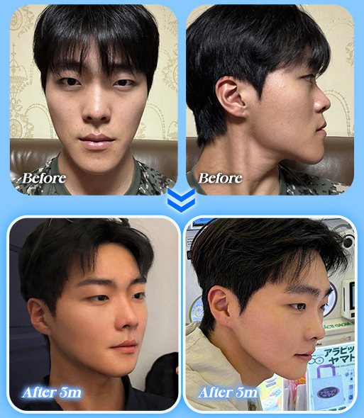 양악+윤곽 전후 사진 CASE 4(남성, 정면·측면 Before / After 3m)
