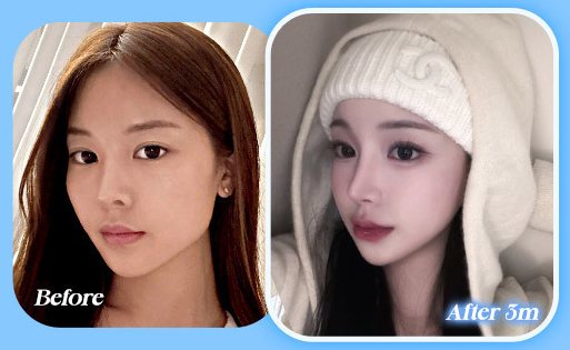 안면윤곽 전후 사진 CASE 1(Before / After 3m)