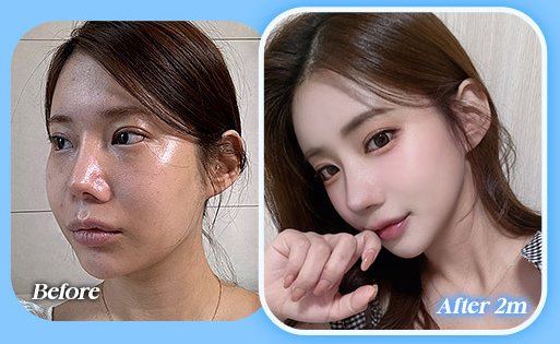 안면윤곽 전후 사진 CASE 2(Before / After 2m)