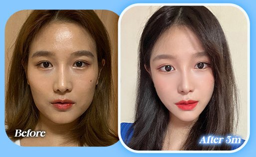 안면윤곽 전후 사진 CASE 4(Before / After 3m)
