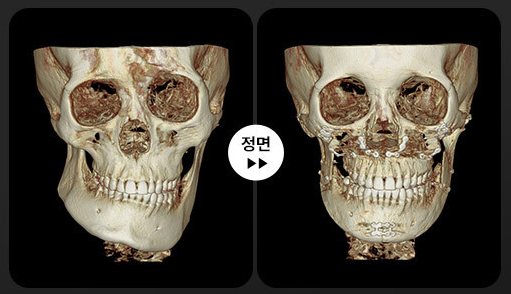 양악+윤곽 3D-CT 전후 1(정면)