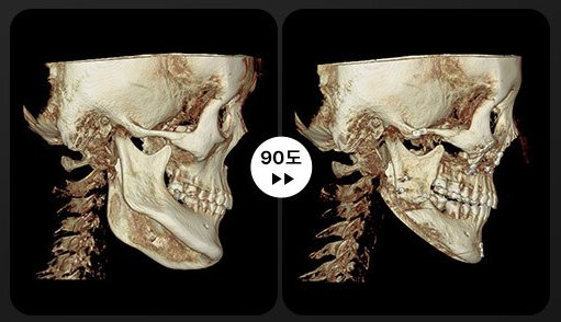 양악+윤곽 3D-CT 전후 1(90도)