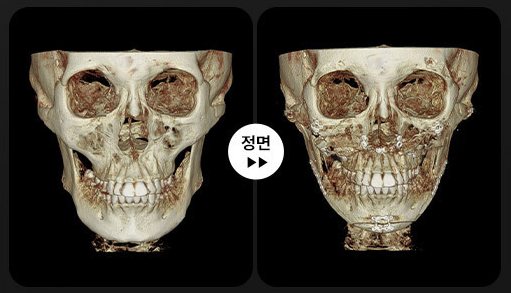 양악+윤곽 3D-CT 전후 2(정면)