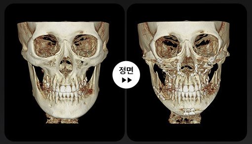 양악+윤곽 3D-CT 전후 3(정면)