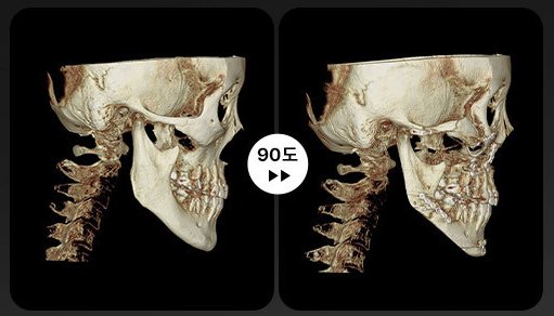양악+윤곽 3D-CT 전후 3(90도)