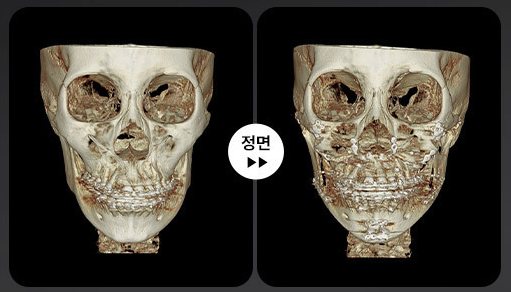 양악+윤곽 3D-CT 전후 4(정면)