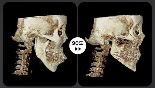 양악+윤곽 3D-CT 전후 4(90도)