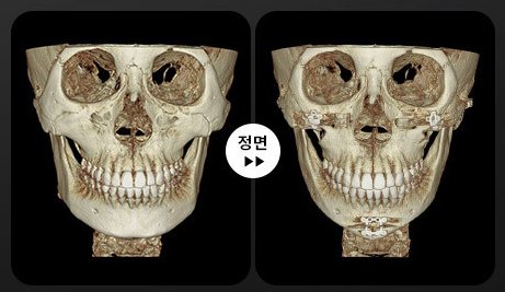 안면윤곽 3D-CT 전후 1(정면)