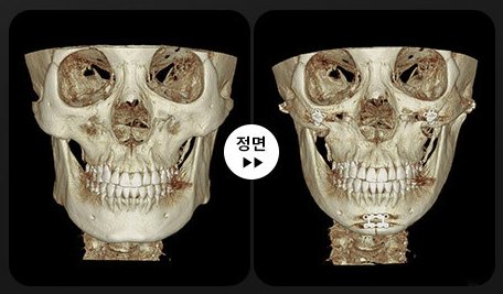 안면윤곽 3D-CT 전후 2(정면)
