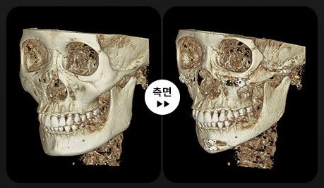 안면윤곽 3D-CT 전후 3(측면)