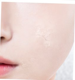 각질이 일어난 볼 피부 클로즈업(악화된 피부 상태)