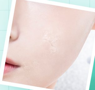 각질이 일어난 볼 피부 클로즈업