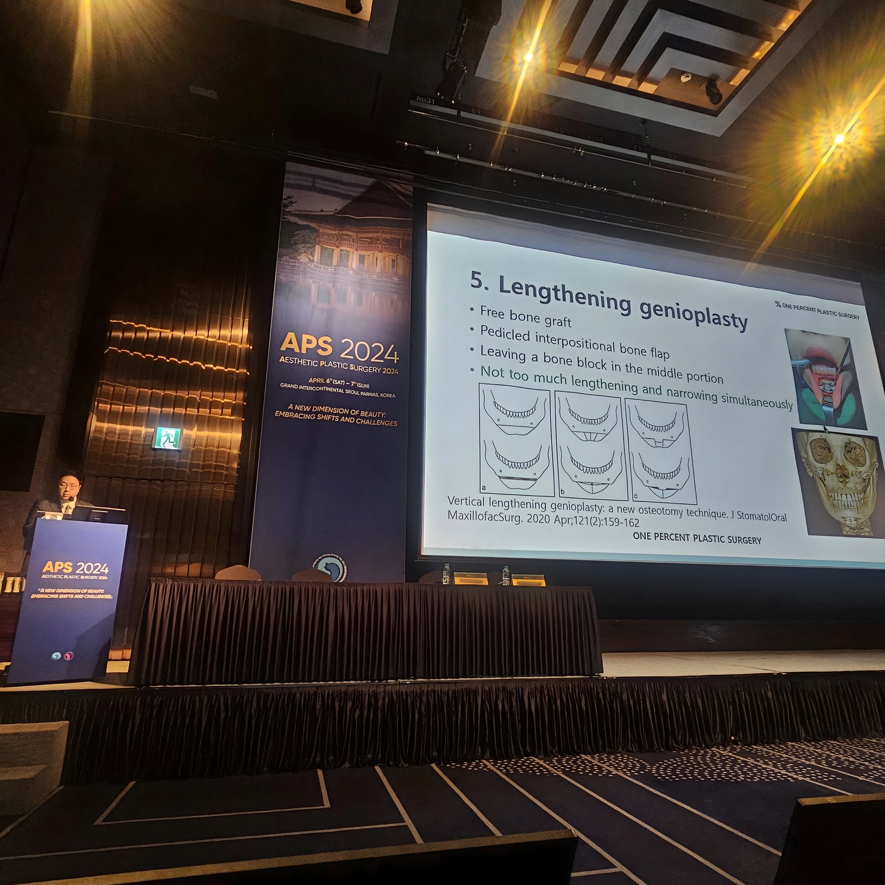 발표 장면 — '5. Lengthening genioplasty' 슬라이드
