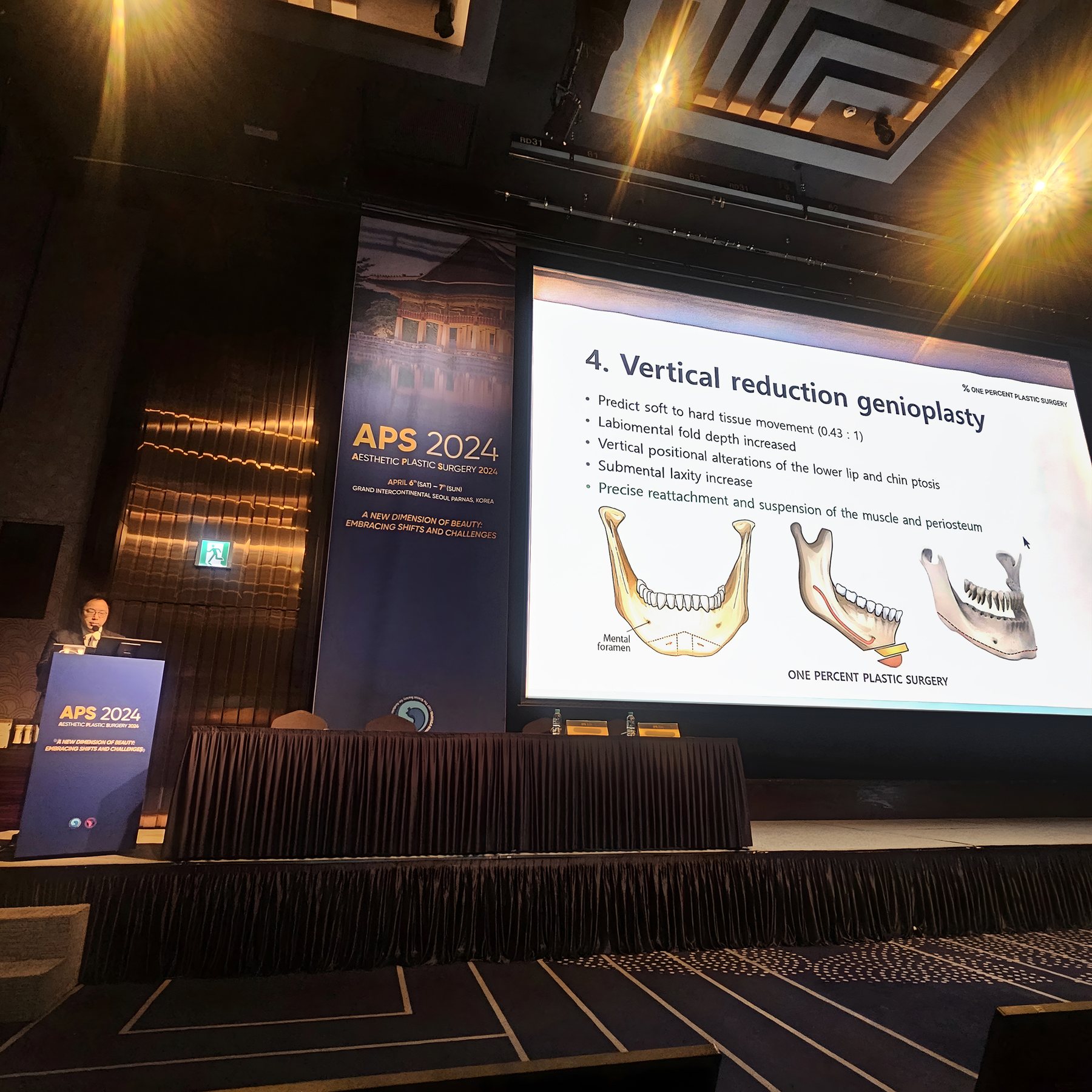 발표 장면 — '4. Vertical reduction genioplasty' 슬라이드