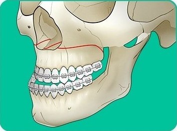 르포트1(LeFort I) — 상악골 수평 절단선을 표시한 턱뼈 일러스트