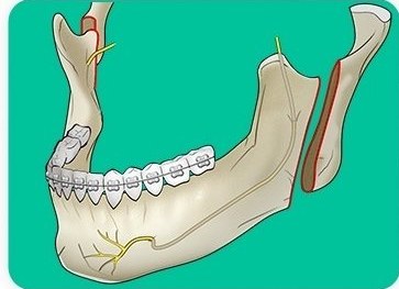 수직골절단술(IVRO) — 아래턱 후방 수직 절골선을 표시한 하악 일러스트