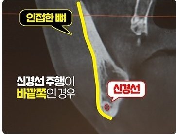 신경선 주행이 바깥쪽인 경우 — 인접한 뼈·신경선을 표시한 CT 단면