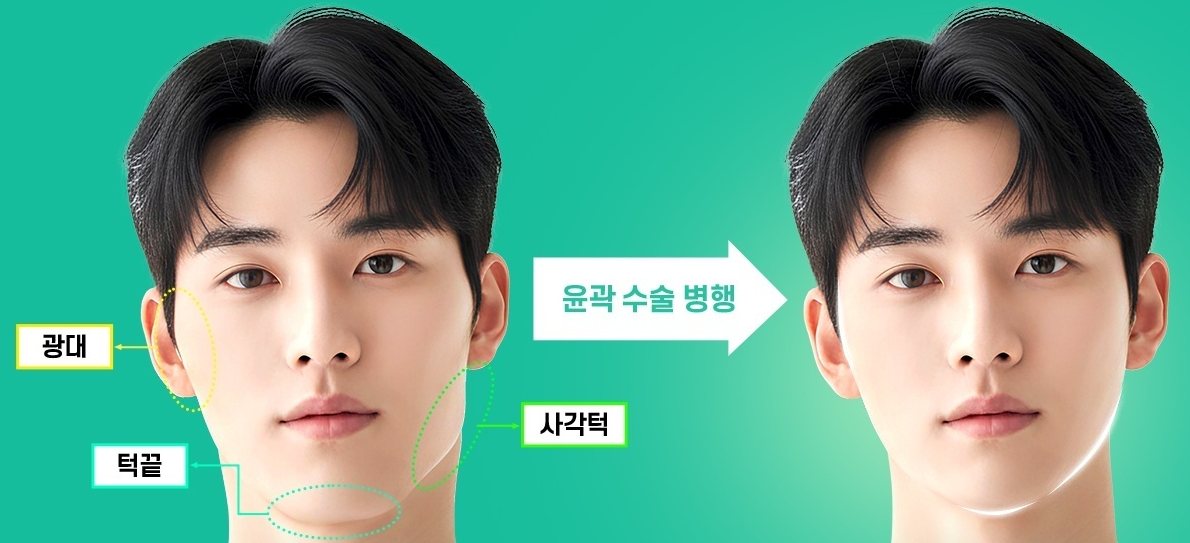 광대·사각턱·턱끝을 점선으로 표시한 남성 얼굴과 ‘윤곽 수술 병행’ 화살표 후 턱선이 정리된 얼굴 비교