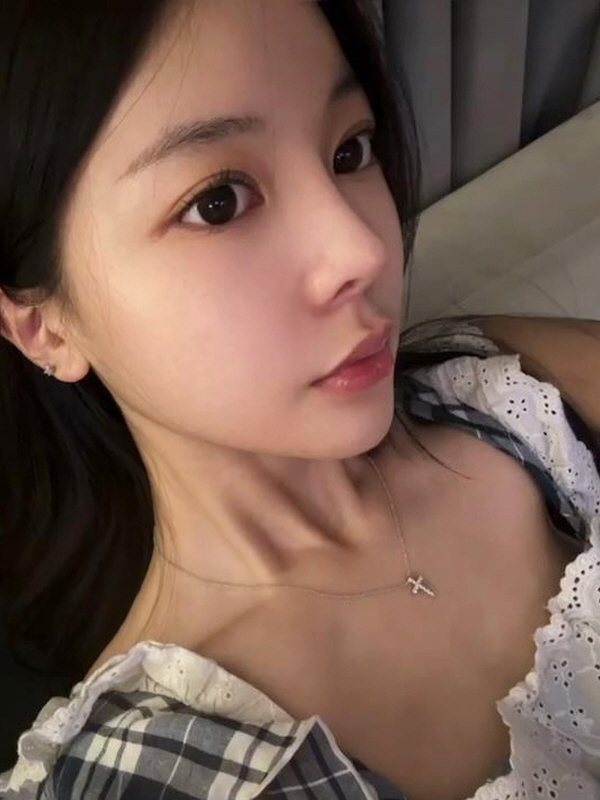 수술 후 2개월 셀피 (2/2)
