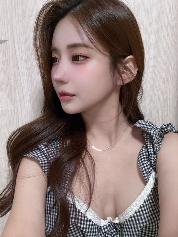 수술 후 3개월 셀피 (2/2)