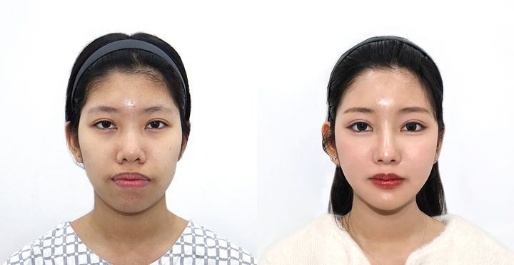 양악, High-3D 광대, 비스포크 미니V라인, 이마지방이식, 실리프팅, 입술필러 전후 사진