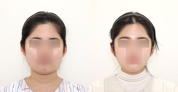 High-3D 광대, 비스포크 V라인, 핸드메이드 지방흡입 전후 사진