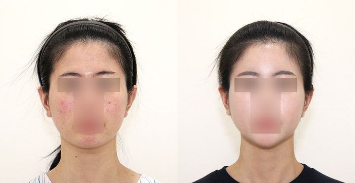 비스포크 미니V라인, 풀페이스 지방이식 전후 사진