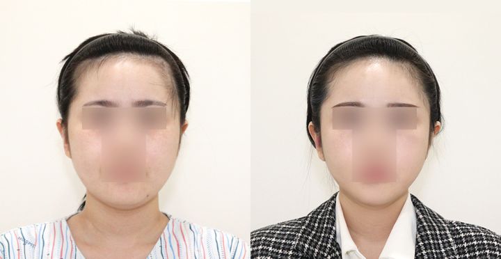 High-3D 광대, 비스포크 V라인, 핸드메이드 지방흡입 전후 사진