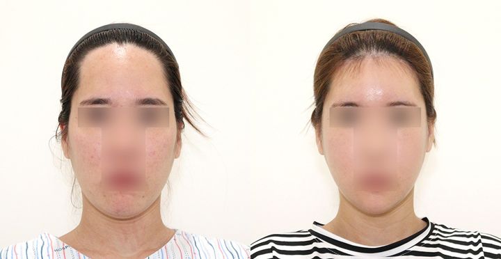 High-3D 광대, 비스포크 V라인, 이마축소, 핸드메이드 지방흡입 전후 사진