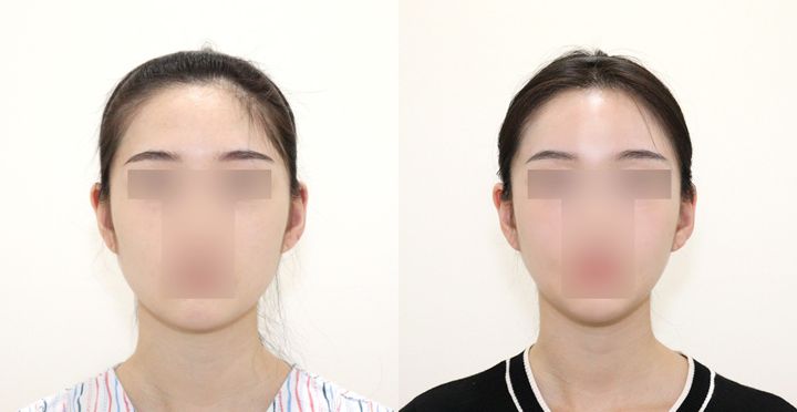 재수술-High-3D 광대, 올포원 사각턱, 풀페이스 지방이식 전후 사진