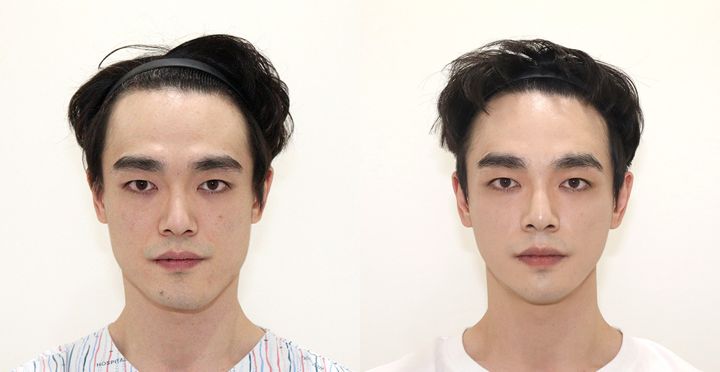 비스포크 V라인, 풀페이스 지방이식 전후 사진
