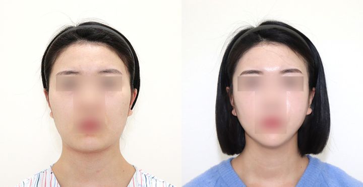 High-3D 광대, 비스포크 V라인, 핸드메이드 지방흡입 전후 사진