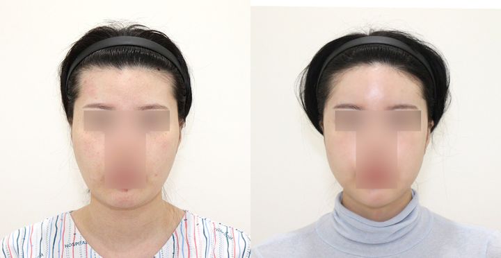 High-3D 광대, 비스포크 V라인, 이마지방이식 전후 사진
