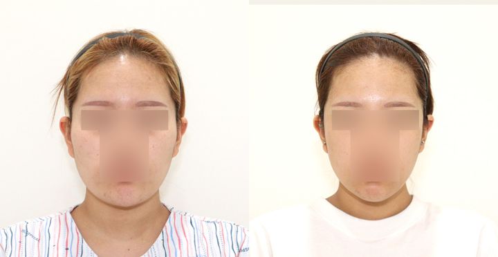 High-3D 광대, 비스포크 V라인, 핸드메이드 지방흡입 전후 사진