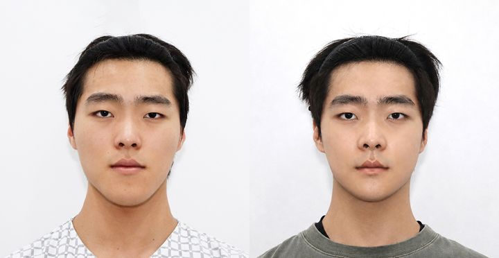 양악, 비스포크 미니V라인 전후 사진