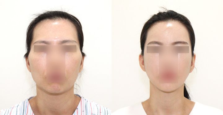 애플존 광대, 비스포크 V라인, 풀페이스 지방이식 전후 사진