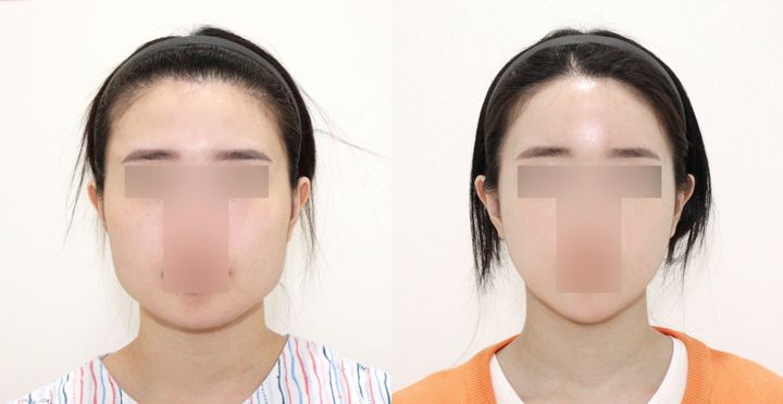 High-3D 광대, 비스포크 V라인, 풀페이스 지방이식, 핸드메이드 지방흡입 전후 사진