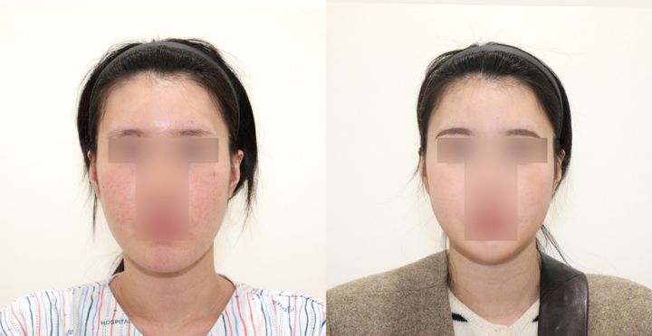 비스포크 미니V라인, 핸드메이드 지방흡입 전후 사진