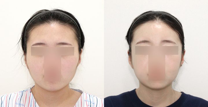 High-3D 광대, 풀페이스 지방이식 전후 사진