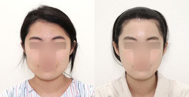 High-3D 광대, 올포원 사각턱, 풀페이스 지방이식, 미니멀절개 스마스리프팅 전후 사진